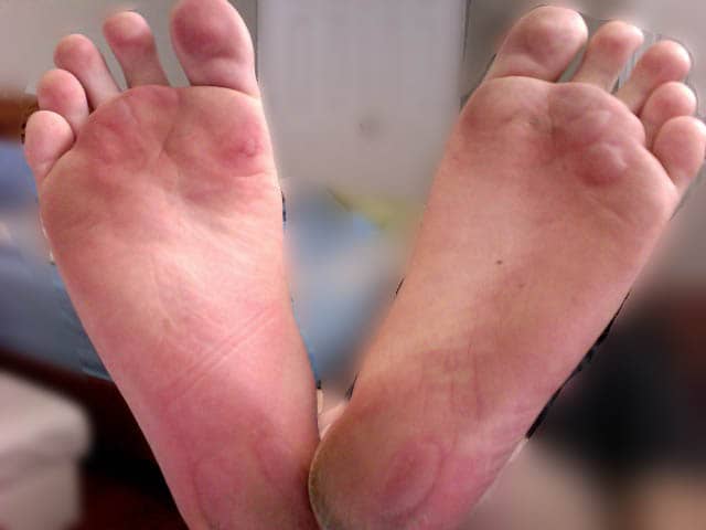 Feet with multiple blisters formed underneath